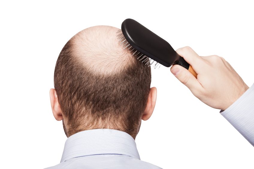 Alopecia - Soporte Natural